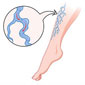 Vascular Conditions