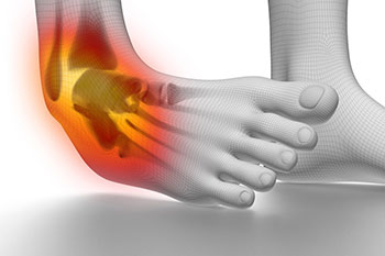 ankle sprain