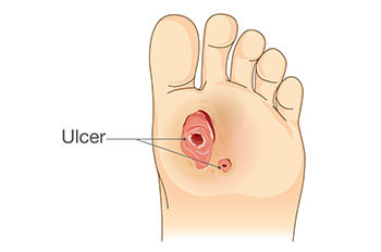 diabetic foot