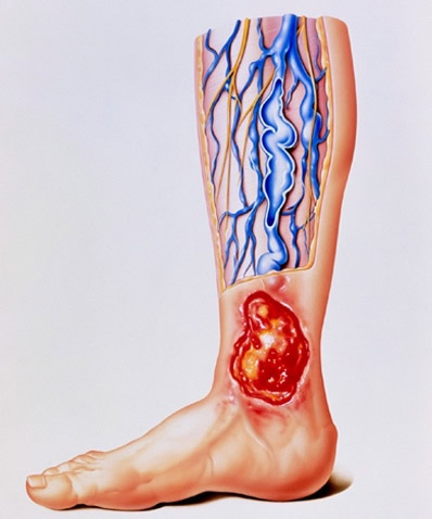 diabetic ulcers