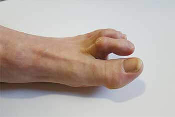 hammertoe