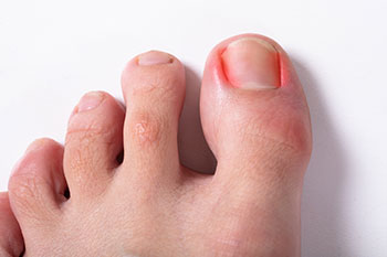 ingrown toenail