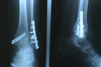 foot and ankle fractures