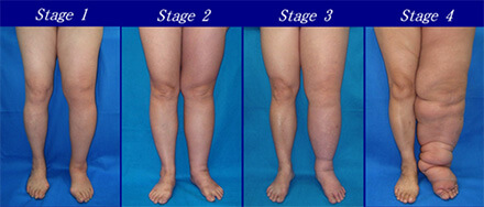 lymphedema