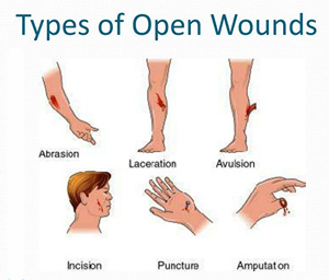 type of open wounds