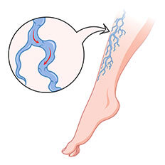 venous ulcers