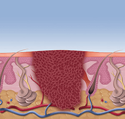 Swift treatment South Amboy, NJ 08879 Swift treatment in the South Amboy, NJ 08879 & Edison, NJ 08837 areas