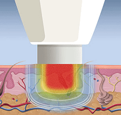 Swift Wart Care Swift Wart Care in the South Amboy, NJ 08879 & Edison, NJ 08837 areas
