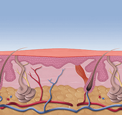 Swift wart treatment South Amboy, NJ 08879 Swift wart treatment in the South Amboy, NJ 08879 & Edison, NJ 08837 areas