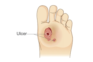 Causes and Treatment of Foot Ulcers