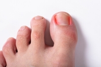 Facts About Ingrown Toenails