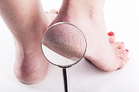 Link Between Vitamin Deficiencies and Cracked Heels