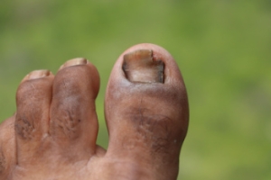 Types and Symptoms of Toenail Fungus
