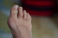 What Causes Hammertoe?